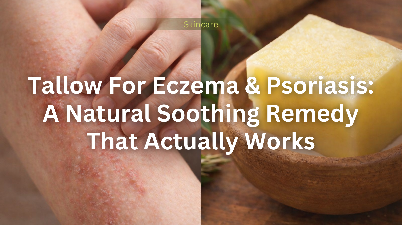 tallow for eczema and psoriasis
